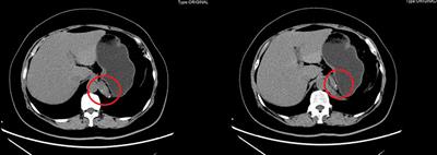 Case report: The safety of laparoscopic surgery for the retroperitoneal bronchogenic cyst